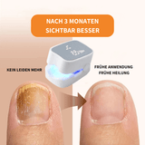 Felivo FungEx® – Revolutionäre Lösung gegen Nagelpilz