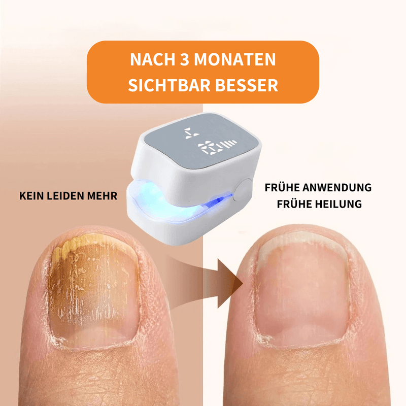 Felivo FungEx® – Revolutionäre Lösung gegen Nagelpilz